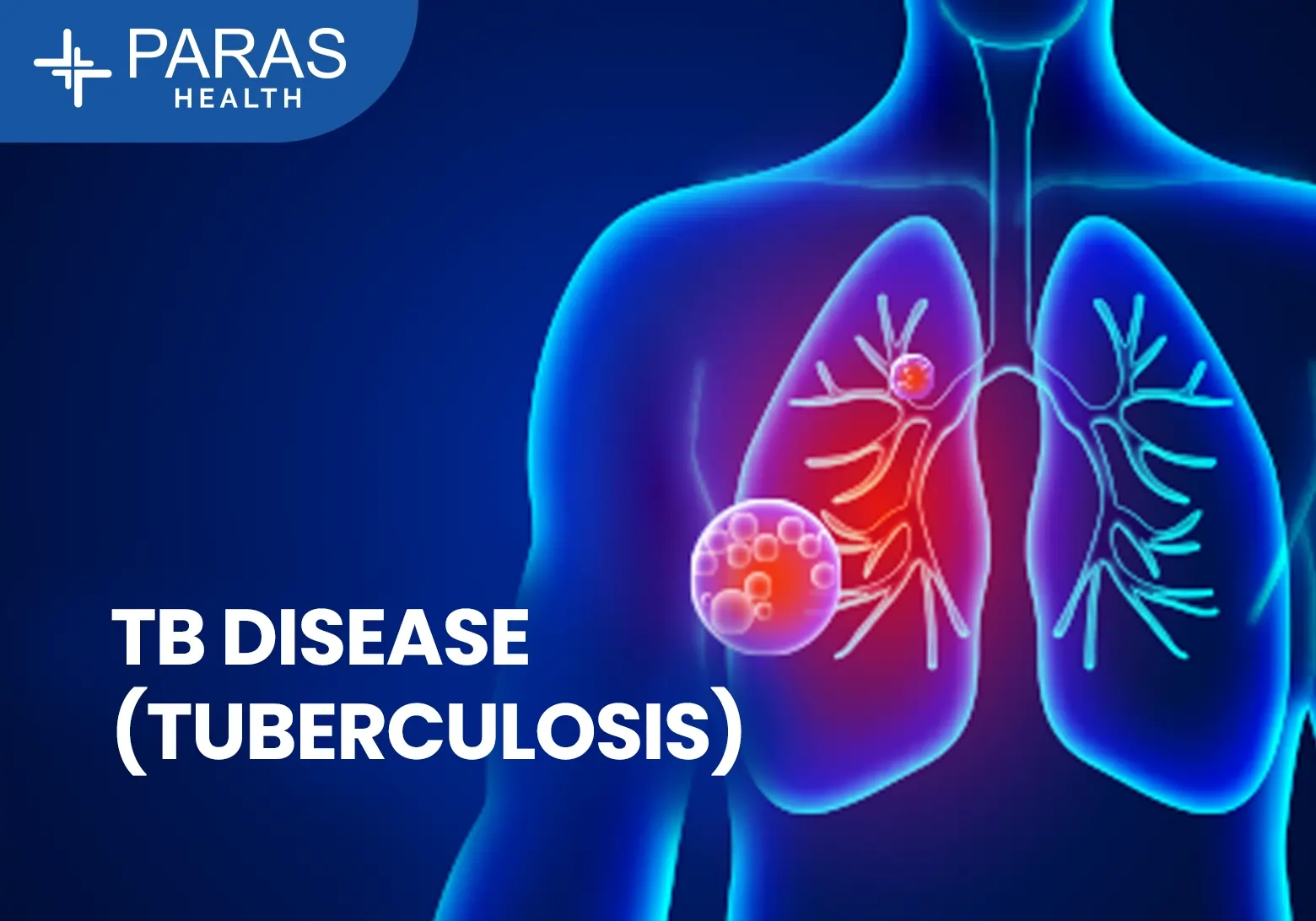 What Is Tuberculosis (TB)
